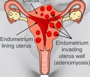 What Is the Difference Between Endometriosis and Adenomyosis?