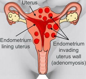 Diffference between Endometriosis and Adenomyosis.
